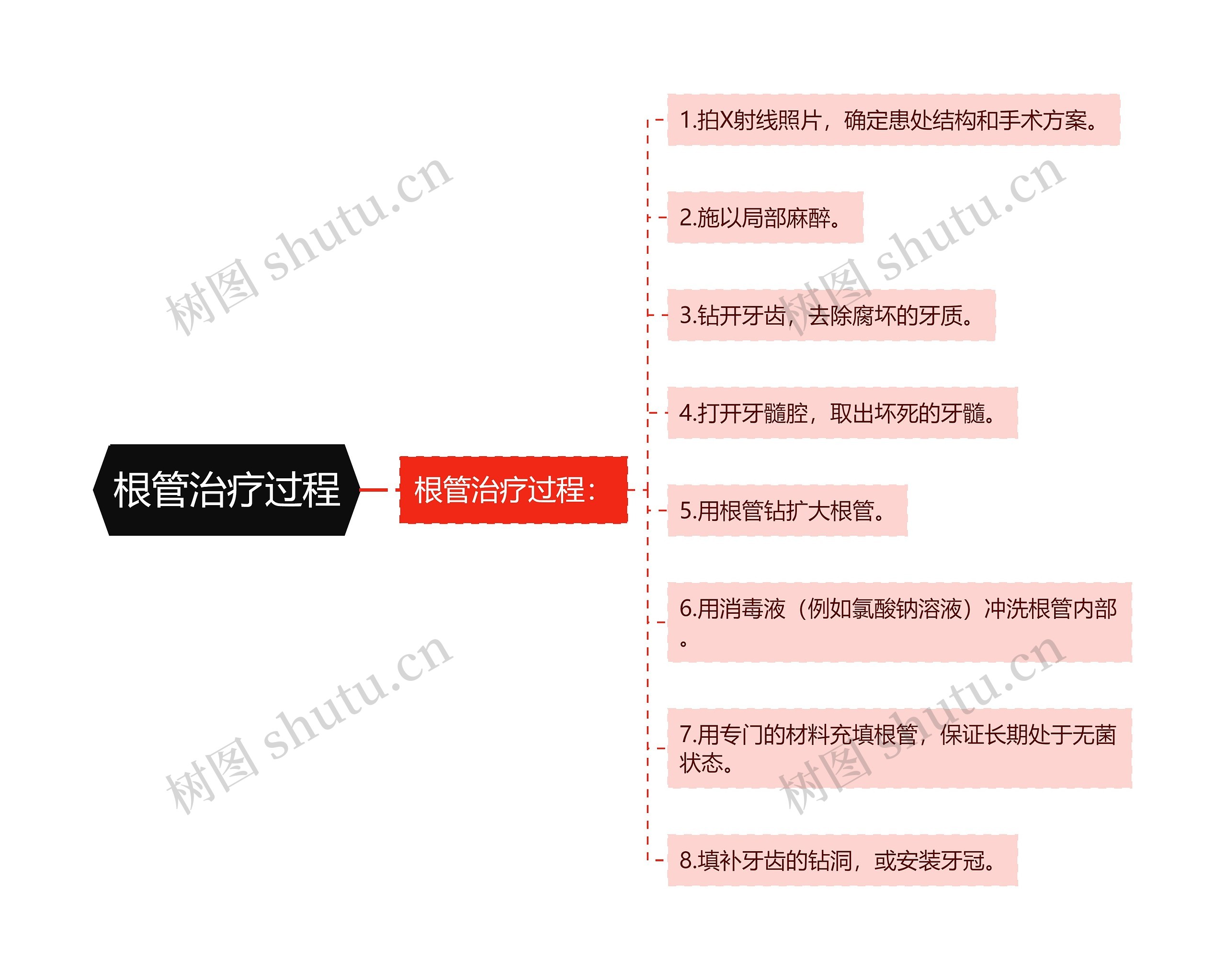 根管治疗过程思维导图